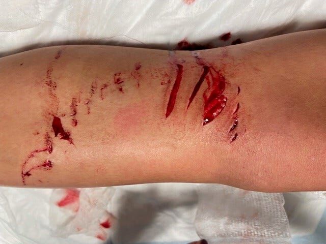 Girl, 12, Recovering After Apparent Shark Bite in Ocean City